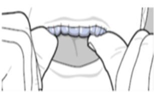 Aligner insertion fingertip placement