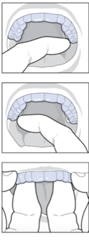 Aligner cleaning supplies and examples