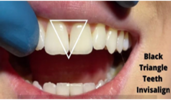 Example of black triangle spacing between teeth